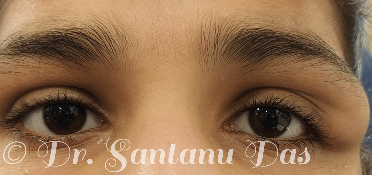 Periocular swelling post physical assault